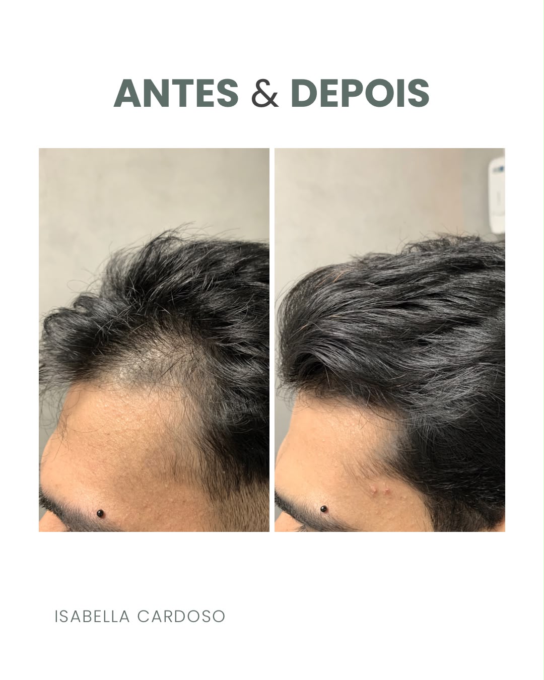 Comparação capilar da região frontal da cabeça, identificada como antes e depois