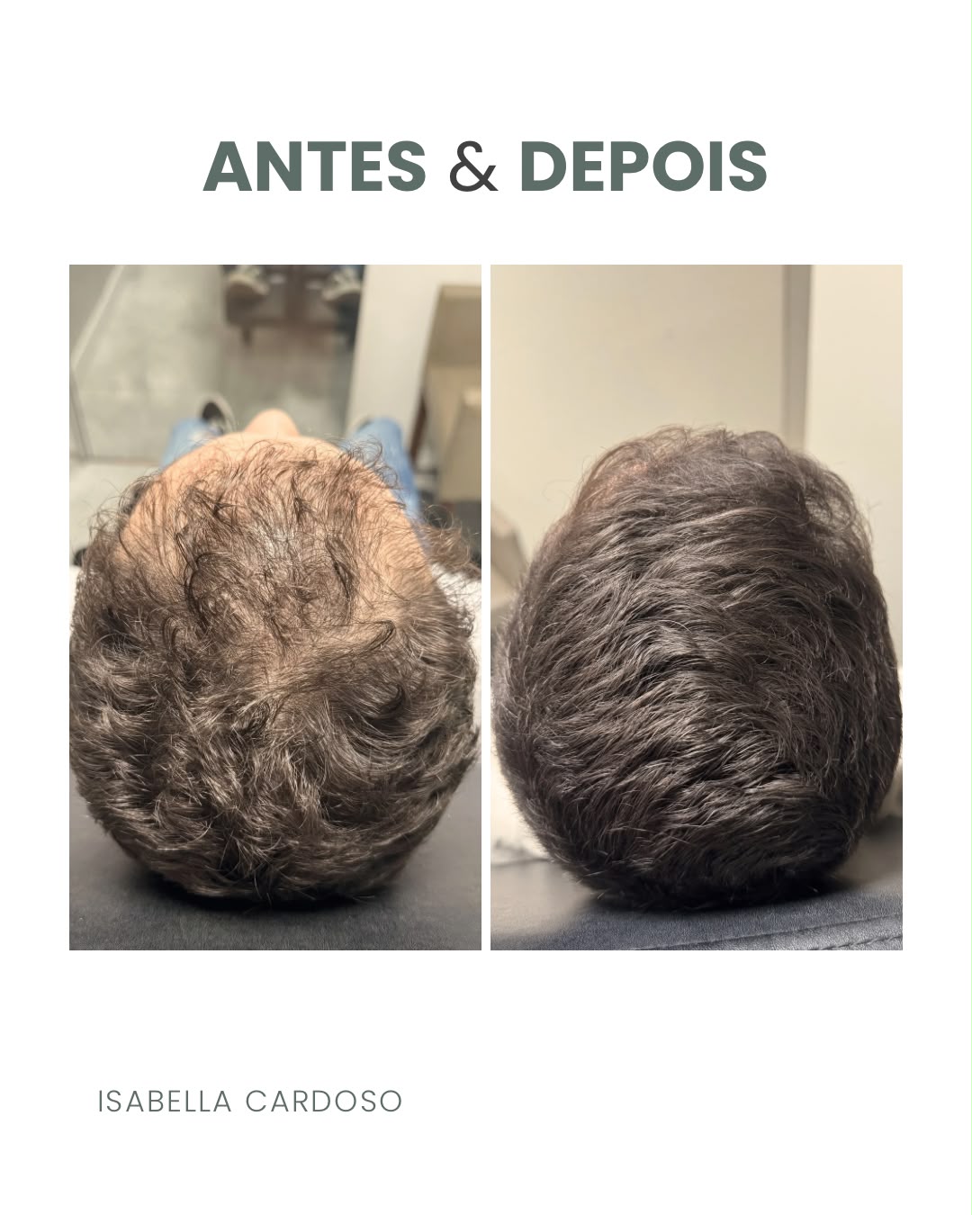 Comparação capilar da região superior da cabeça, identificada como antes e depois