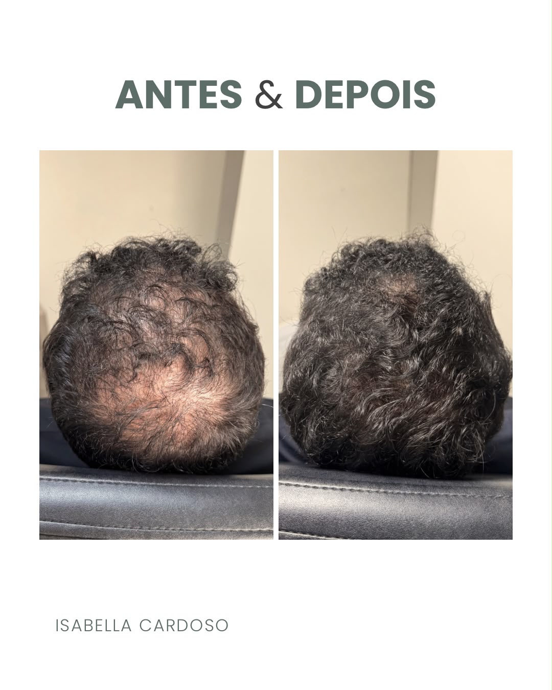 Comparação capilar da região superior da cabeça, identificada como antes e depois