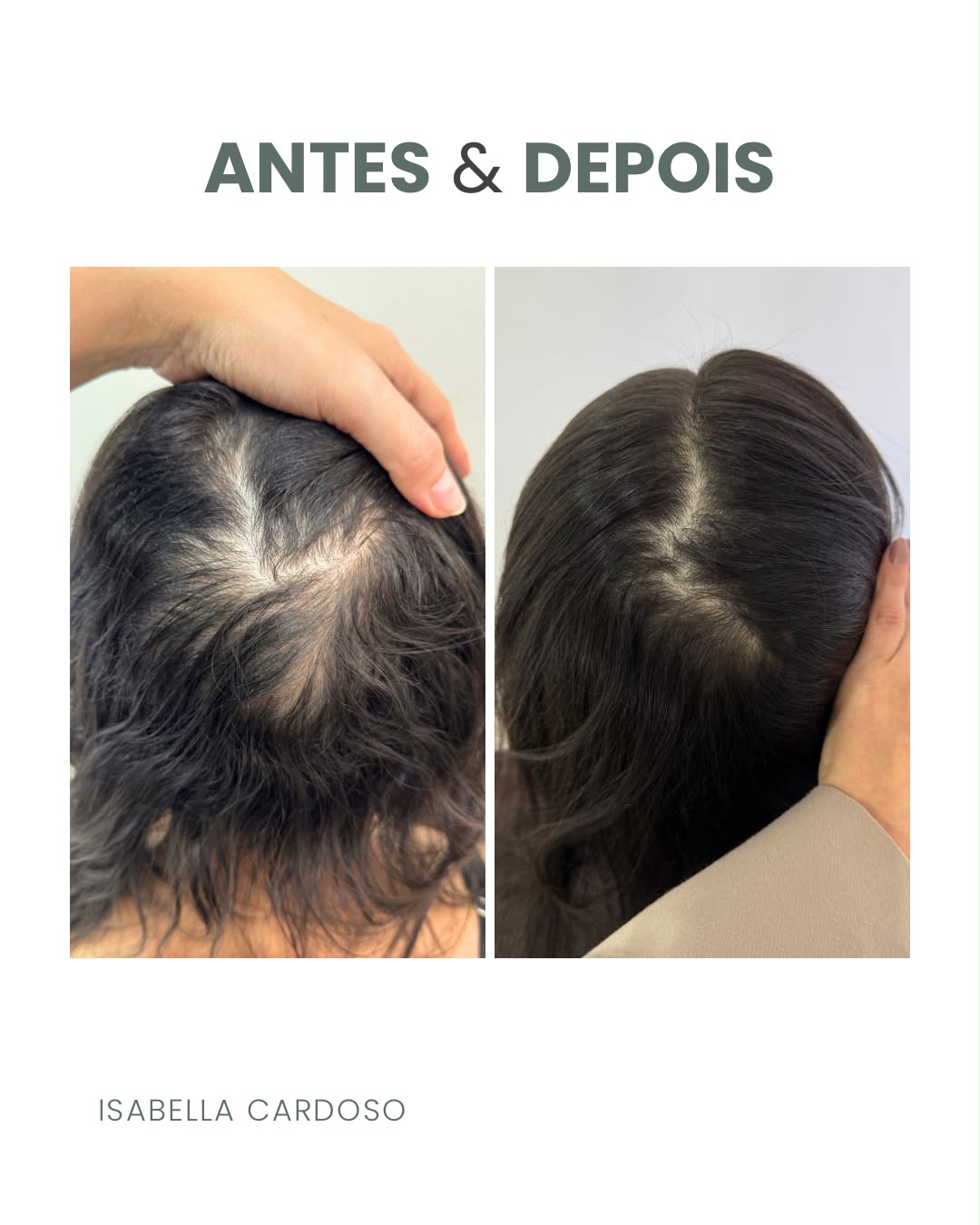 Comparação capilar da risca do cabelo, identificada como antes e depois