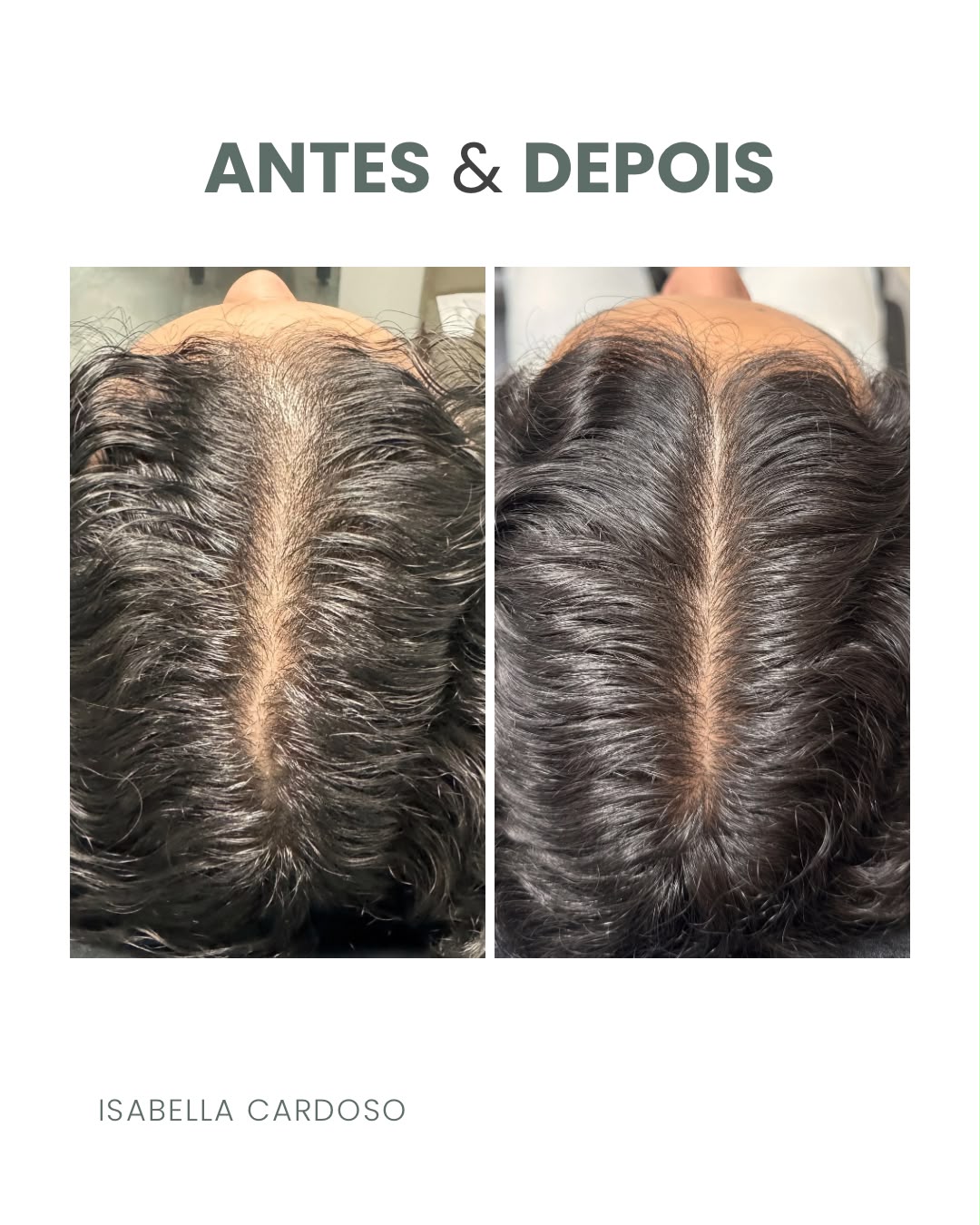 Comparação capilar da risca do cabelo, identificada como antes e depois