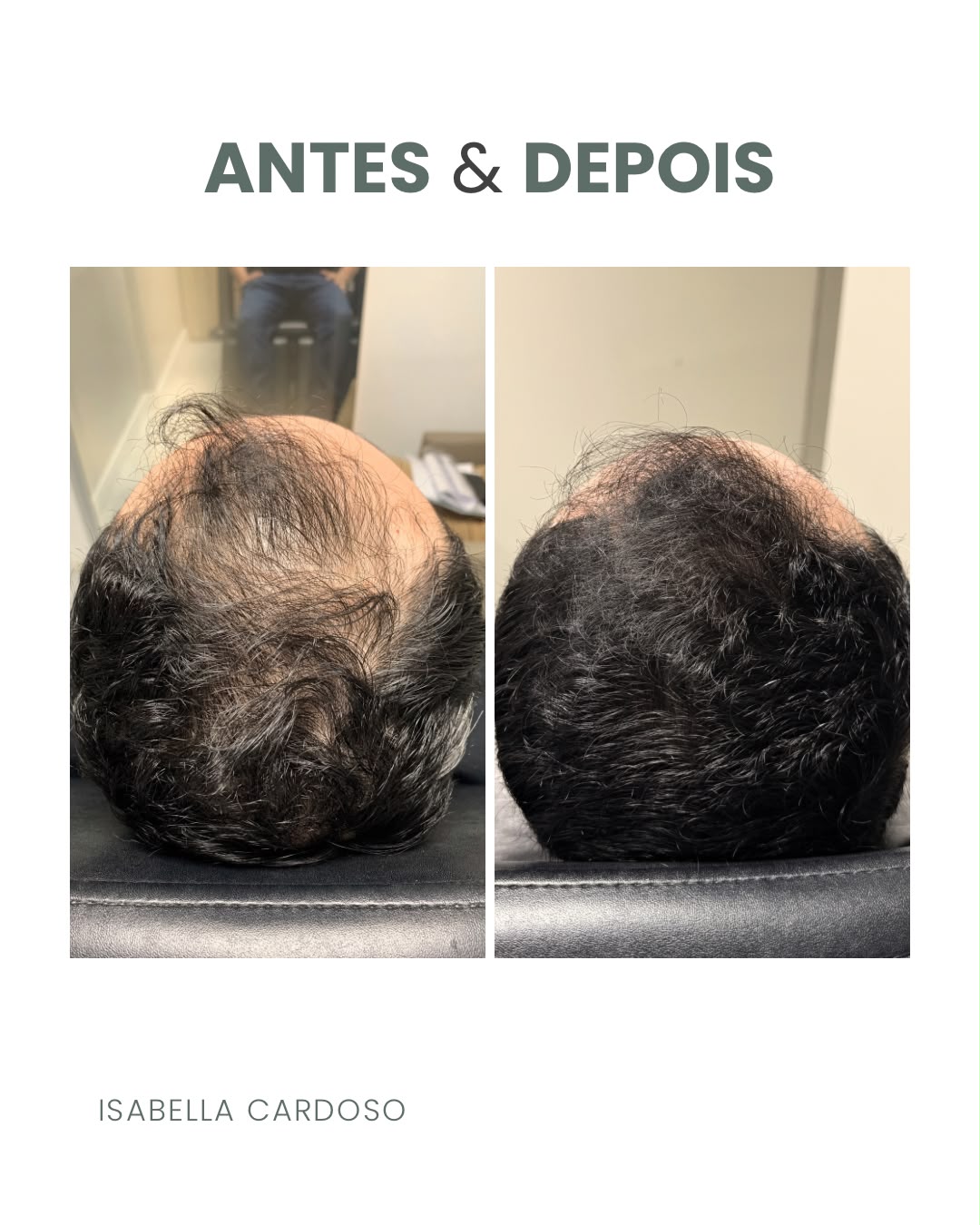 Comparação capilar da região superior da cabeça, identificada como antes e depois